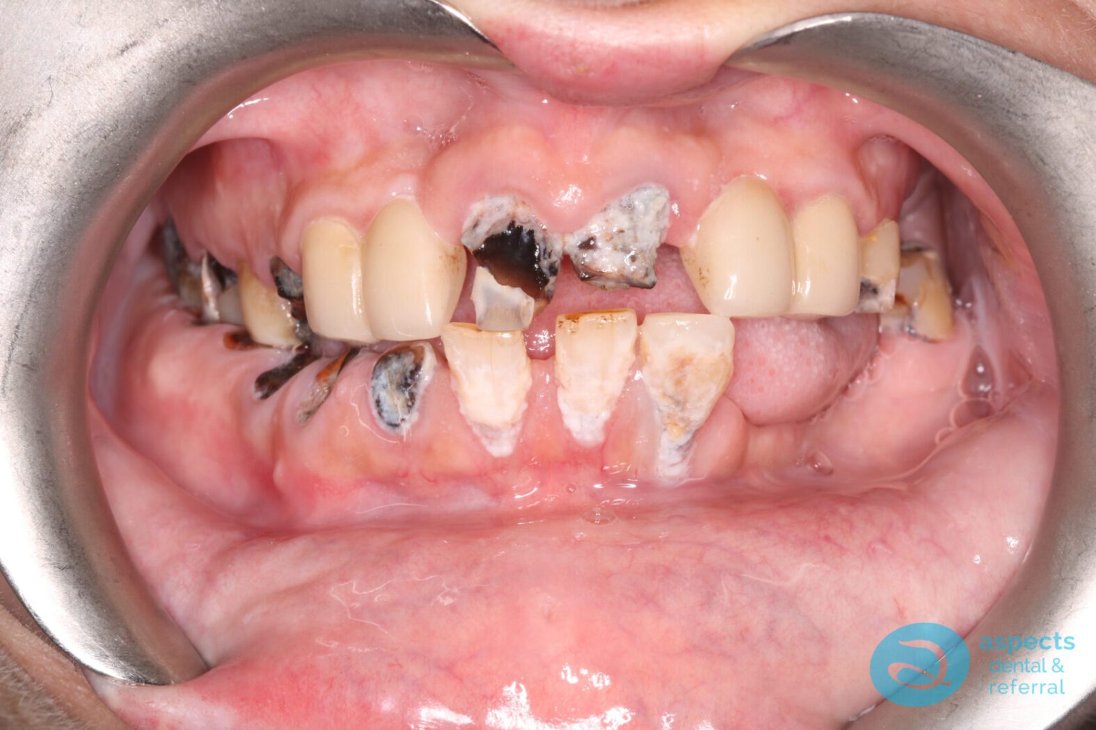 Before Implant-Retained Overdentures Photo - Dental Implants Milton Keynes - Aspects Dental Case Study 19 Before Implant-Retained Overdentures Photo - Dental Implants Milton Keynes - Aspects Dental Case Study 19