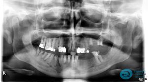 Before Implant-Retained Overdentures Xray - Dental Implants Milton Keynes - Aspects Dental Case Study 19