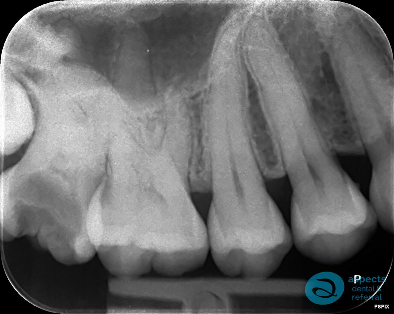 Before Tooth Extraction Photo 1 - Tooth Extraction Milton Keynes - Aspects Dental Case Study 12