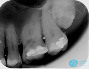 Before Tooth Extraction Photo 2 - Dental Implants Milton Keynes - Aspects Dental Case Study 13