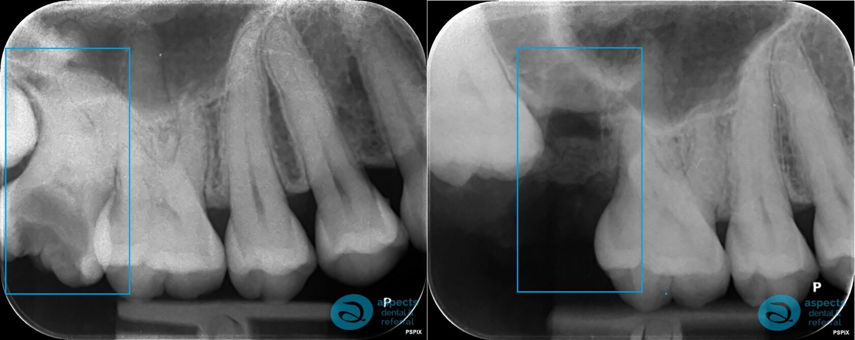Milton Keynes Dentist Completes Surgical Tooth Extraction