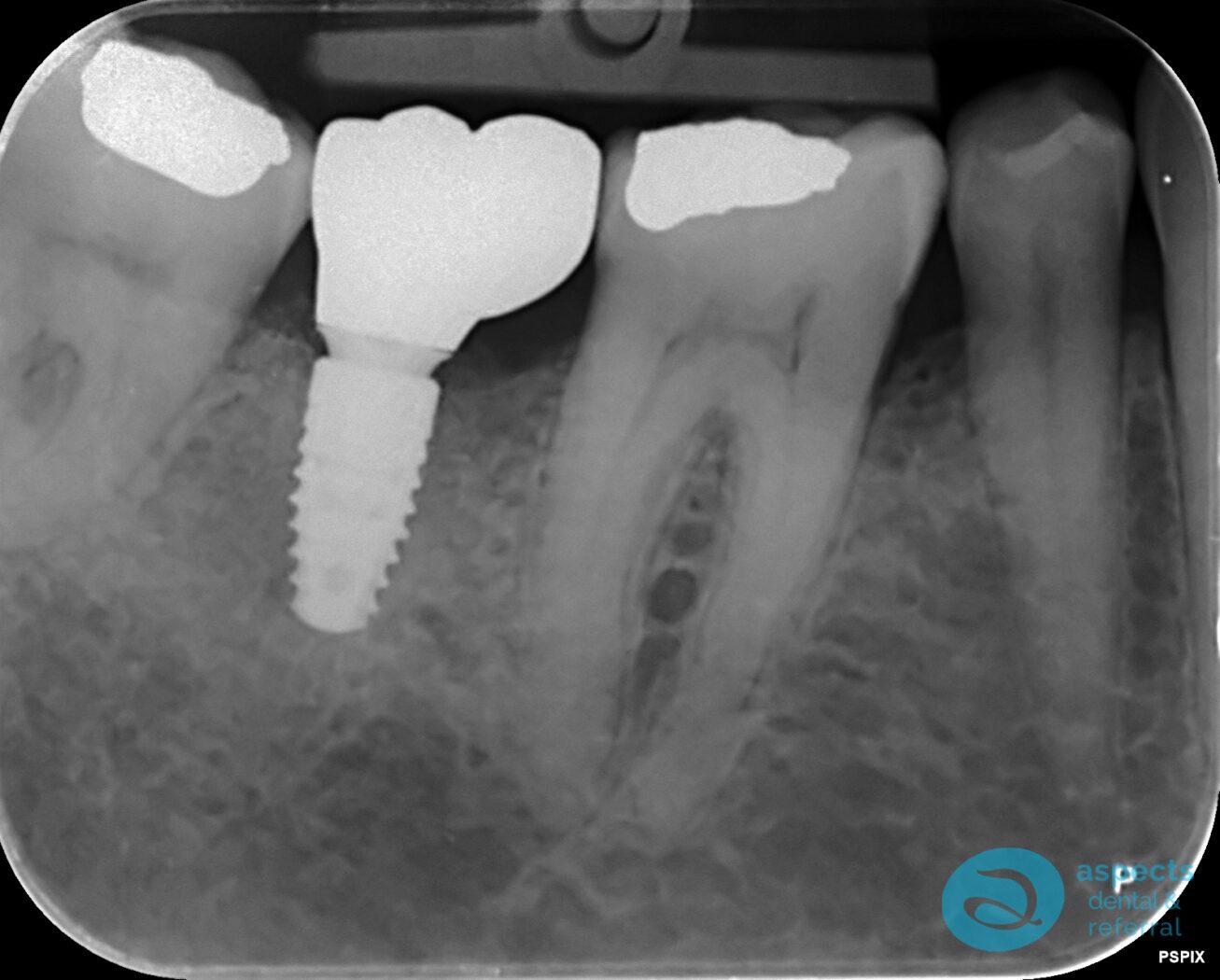 After Dental Implant Photo - Dental Implants Milton Keynes - Aspects Dental Case Study 22 After Dental Implant Photo - Dental Implants Milton Keynes - Aspects Dental Case Study 22