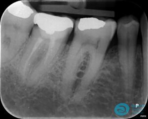 Before Extraction & Implant Photo - Dental Implants Milton Keynes - Aspects Dental Case Study 22