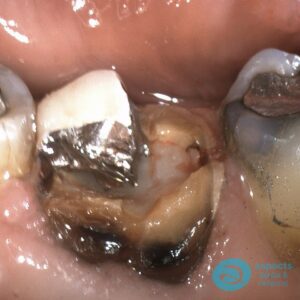 Failing Dental Crown & Tooth Loss - Dental Implants Milton Keynes - Aspects Dental Case Study 22