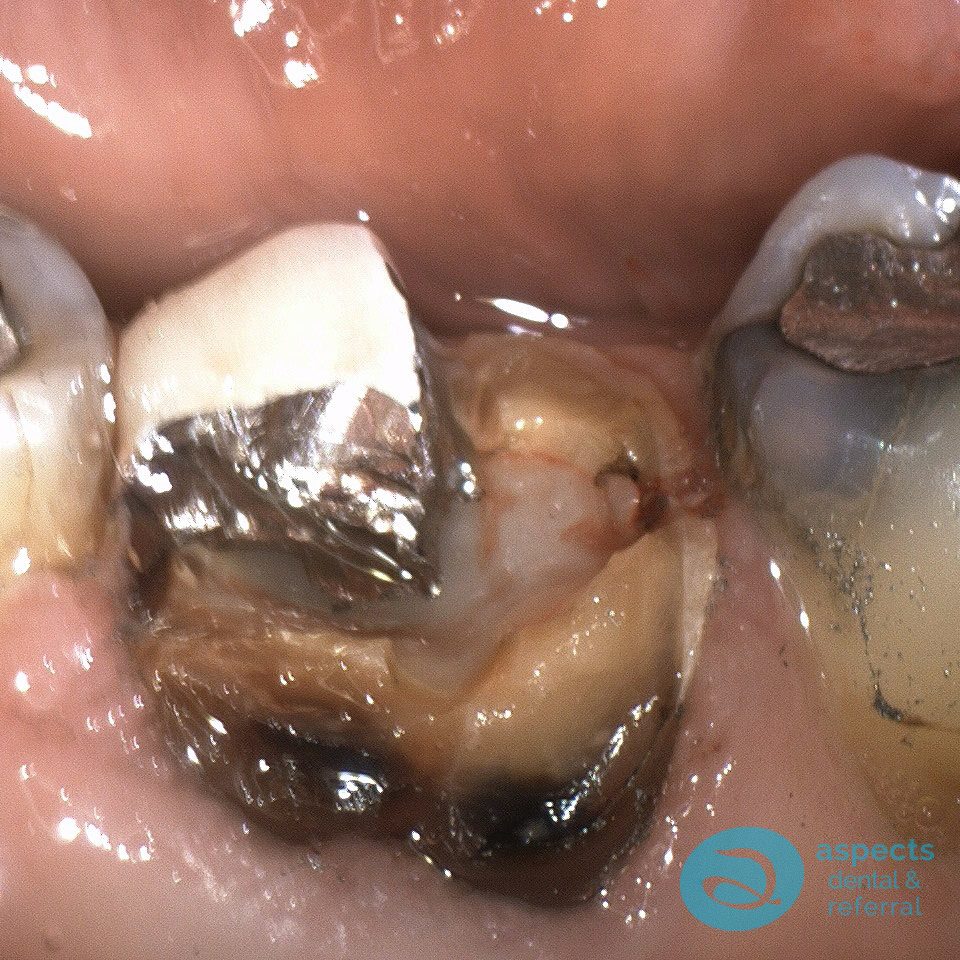 Failing Dental Crown & Tooth Loss - Dental Implants Milton Keynes - Aspects Dental Case Study 22 Failing Dental Crown & Tooth Loss - Dental Implants Milton Keynes - Aspects Dental Case Study 22