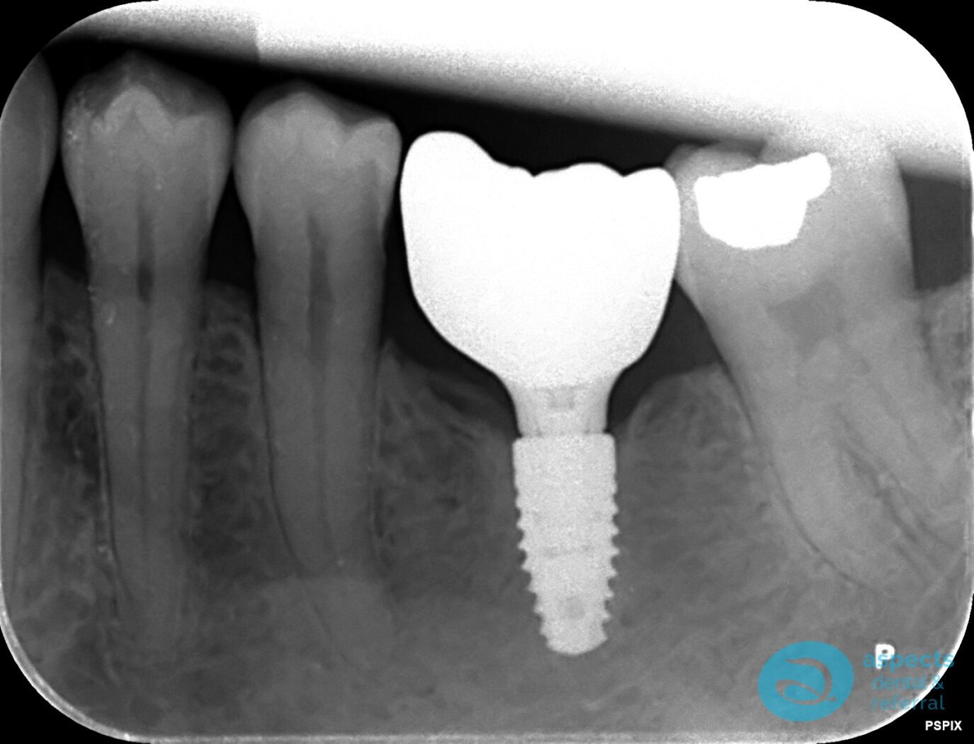 After Dental Implant Photo - Dental Implants Milton Keynes - Aspects Dental Case Study 23