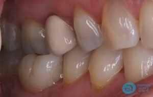 After Dental Implant Photo - Dental Implants Milton Keynes - Aspects Dental Case Study 23