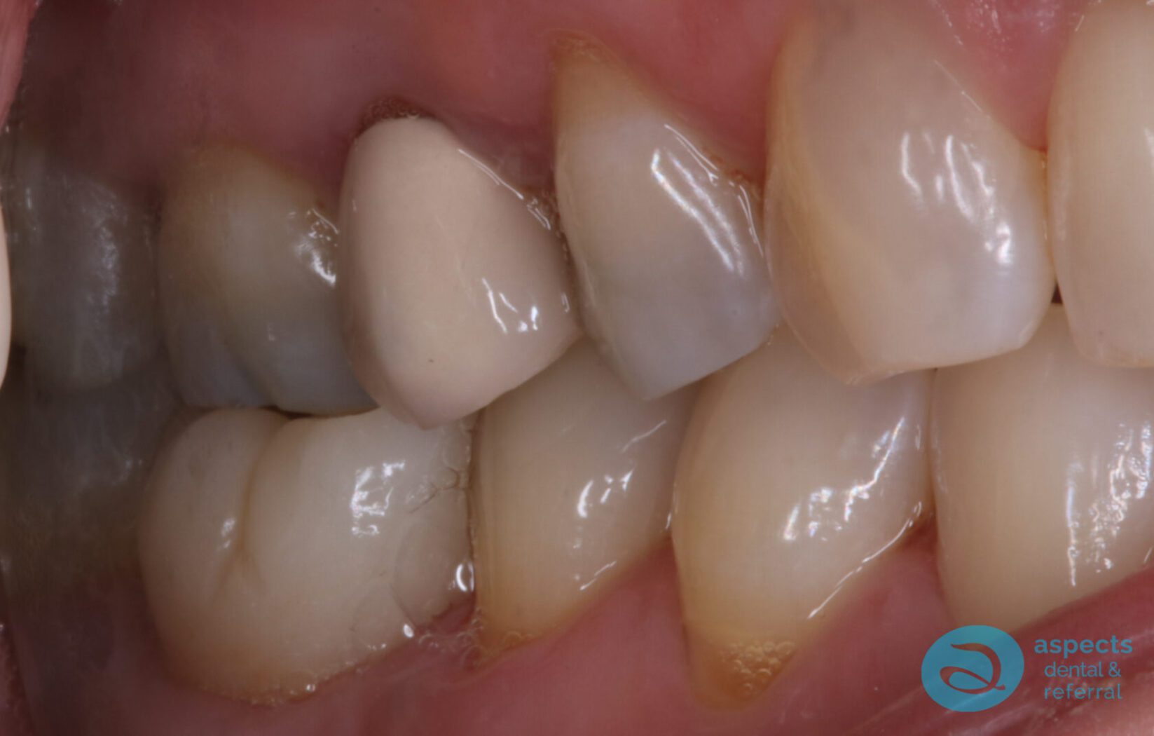 After Dental Implant Photo - Dental Implants Milton Keynes - Aspects Dental Case Study 23