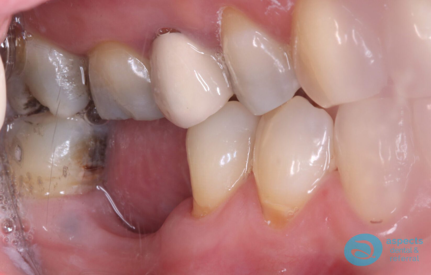 Before Dental Implant Photo - Dental Implants Milton Keynes - Aspects Dental Case Study 23