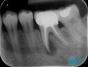 Before Extraction & Implant Photo - Dental Implants Milton Keynes - Aspects Dental Case Study 23