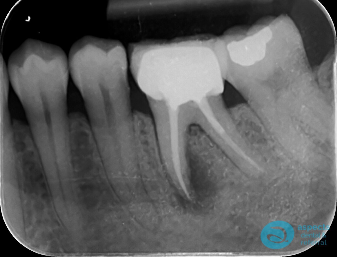 Before Extraction & Implant Photo - Dental Implants Milton Keynes - Aspects Dental Case Study 23