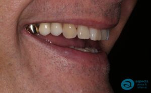 After Dental Implants Photo - Dental Implants Milton Keynes - Aspects Dental Case Study 24