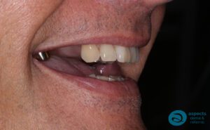 Before Dental Implants Photo - Dental Implants Milton Keynes - Aspects Dental Case Study 24
