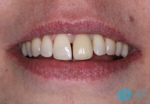 After Dental Implant Photo - Dental Implants Milton Keynes - Aspects Dental Case Study 25