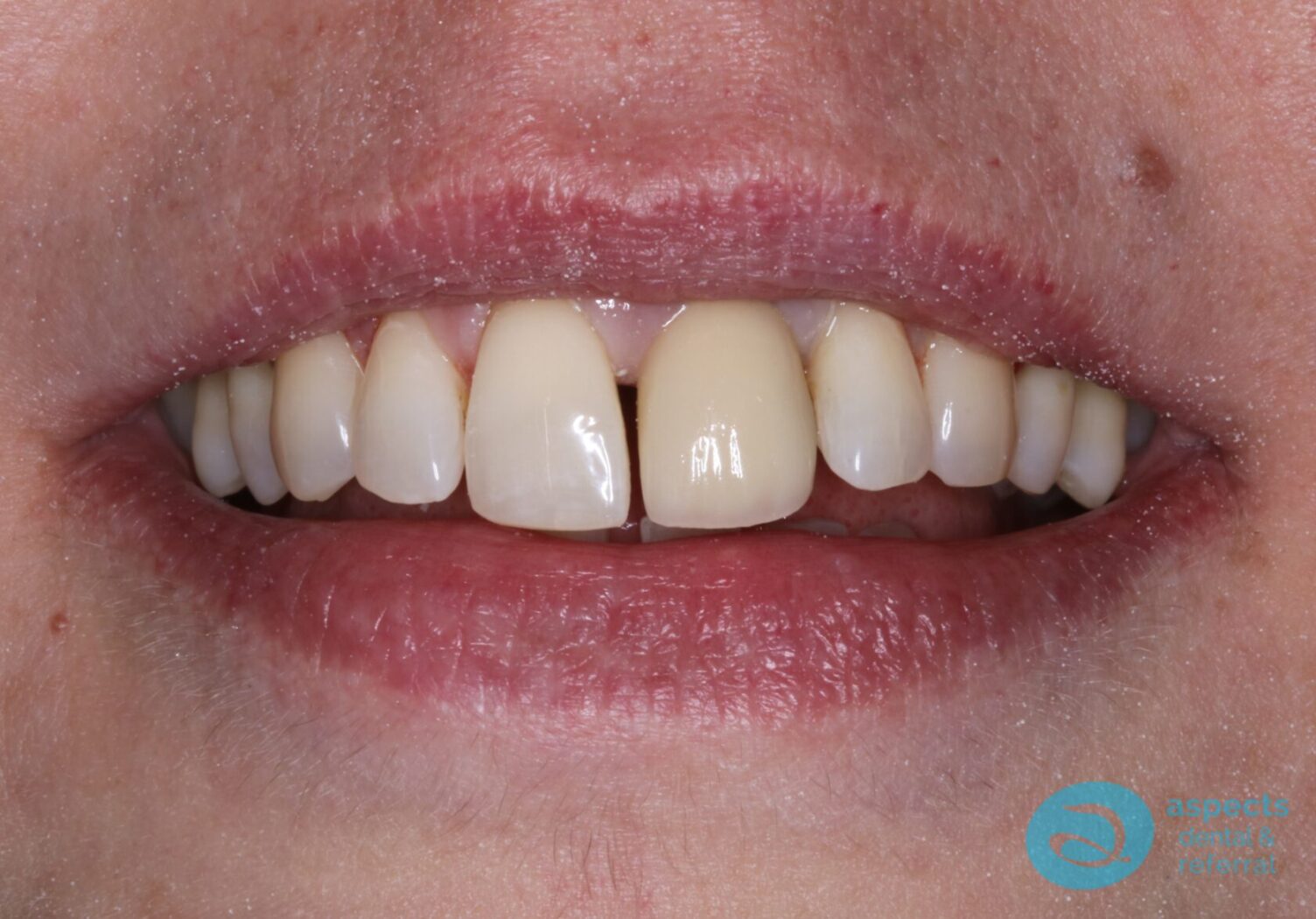 After Dental Implant Photo - Dental Implants Milton Keynes - Aspects Dental Case Study 25