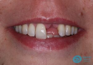 Before Dental Implant Photo - Dental Implants Milton Keynes - Aspects Dental Case Study 25