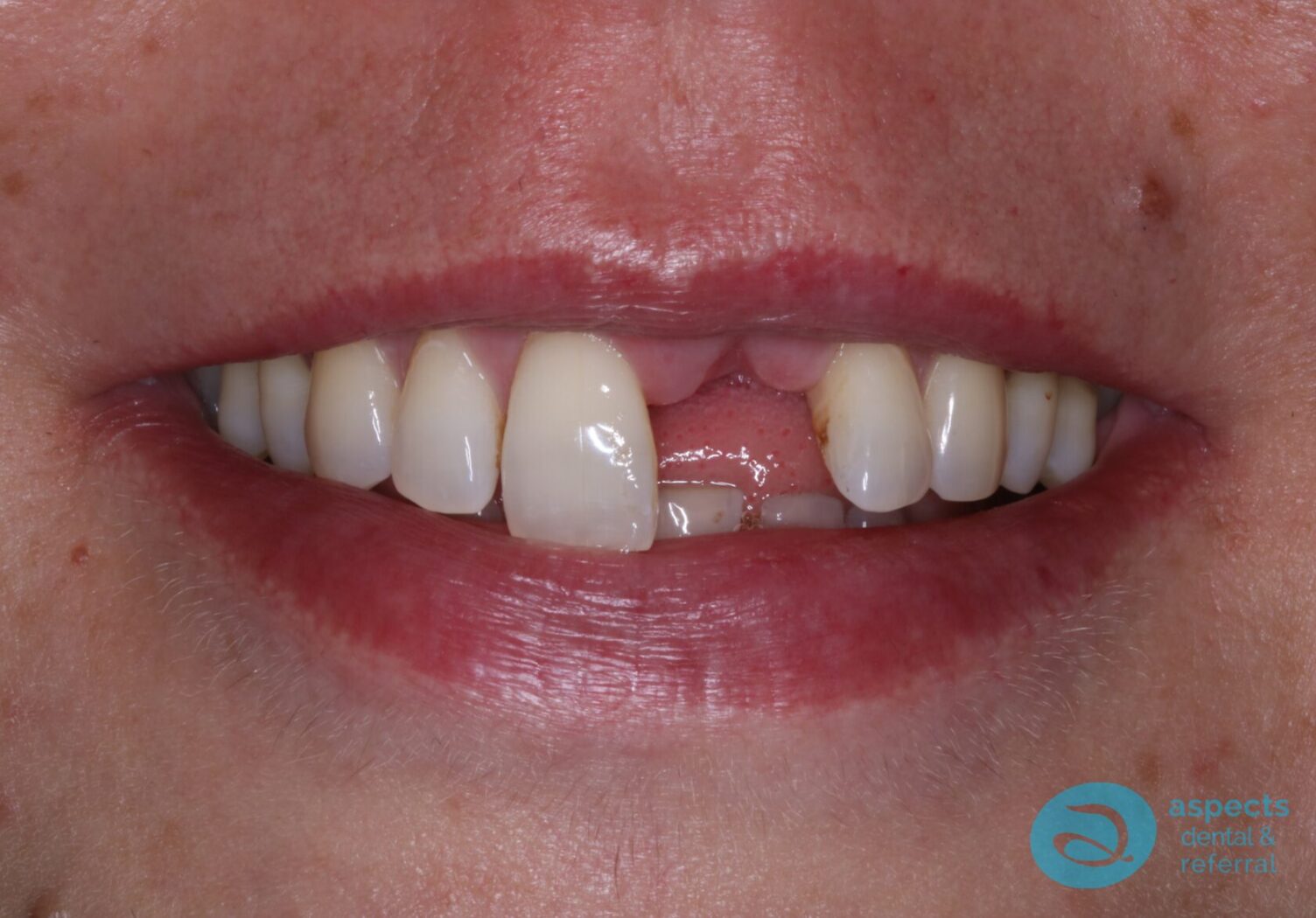 Before Dental Implant Photo - Dental Implants Milton Keynes - Aspects Dental Case Study 25