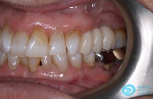 After Dental Implants & Bridge Photo - Dental Implants Milton Keynes - Aspects Case Study 26