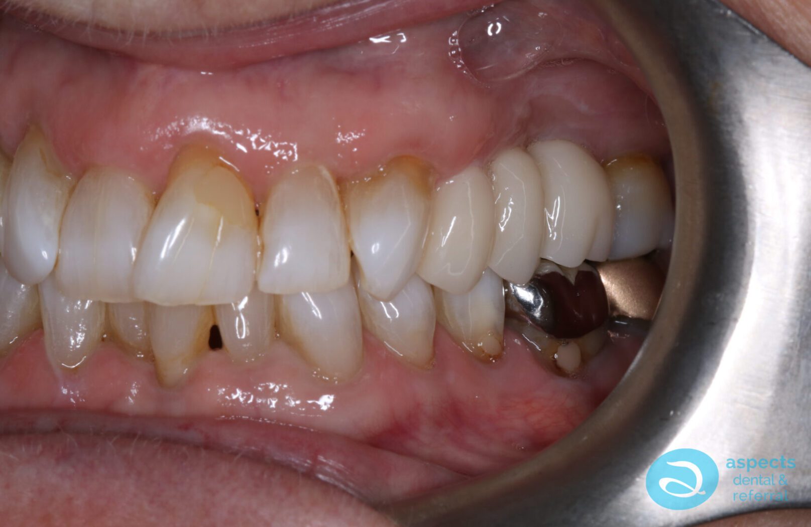 After Dental Implants & Bridge Photo - Dental Implants Milton Keynes - Aspects Case Study 26
