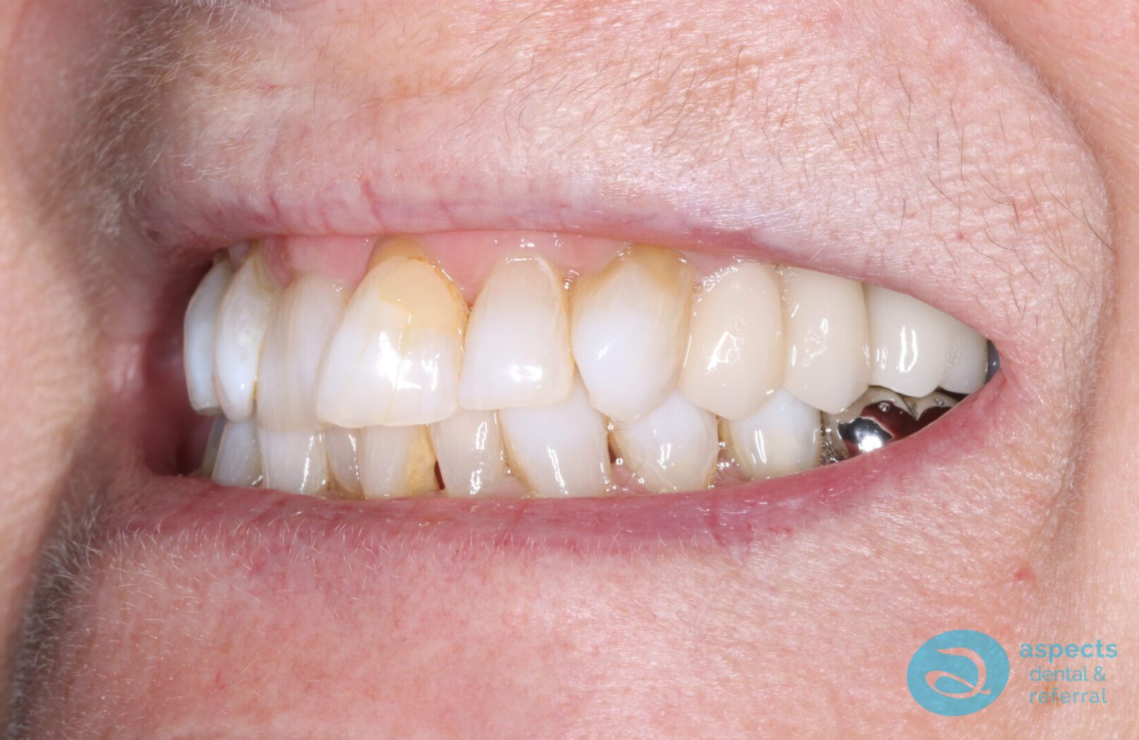 After Dental Implants & Bridge Photo - Dental Implants Milton Keynes - Aspects Dental Case Study 26