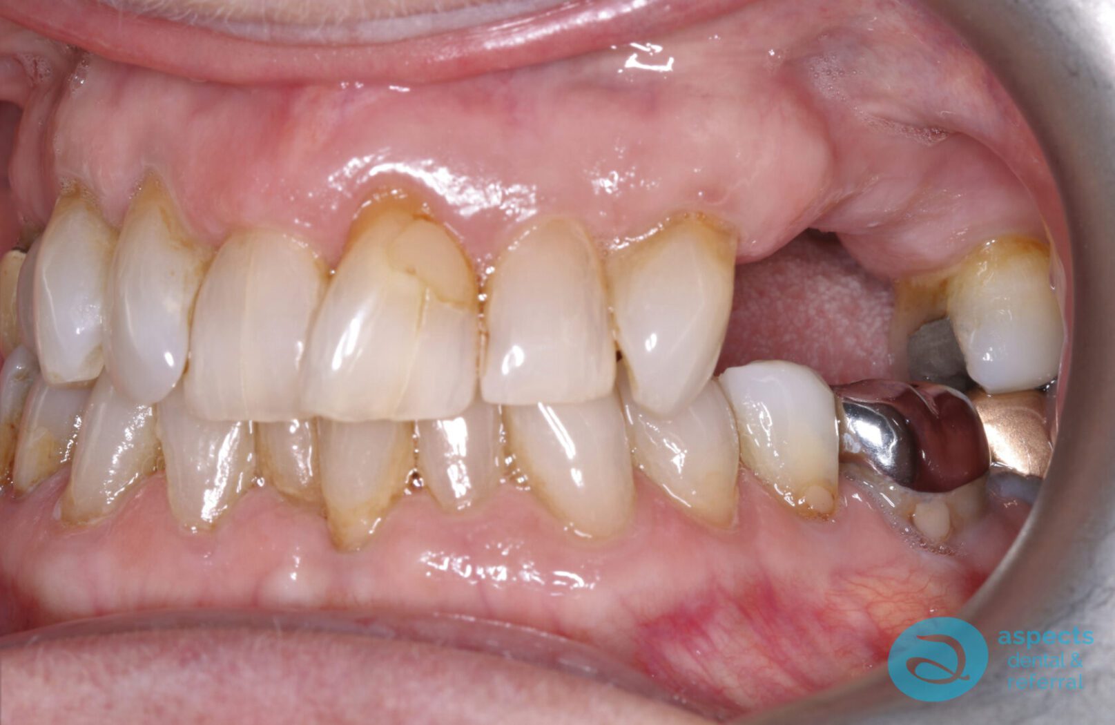 Before Dental Implants & Bridge Photo - Dental Implants Milton Keynes - Aspects Case Study 26