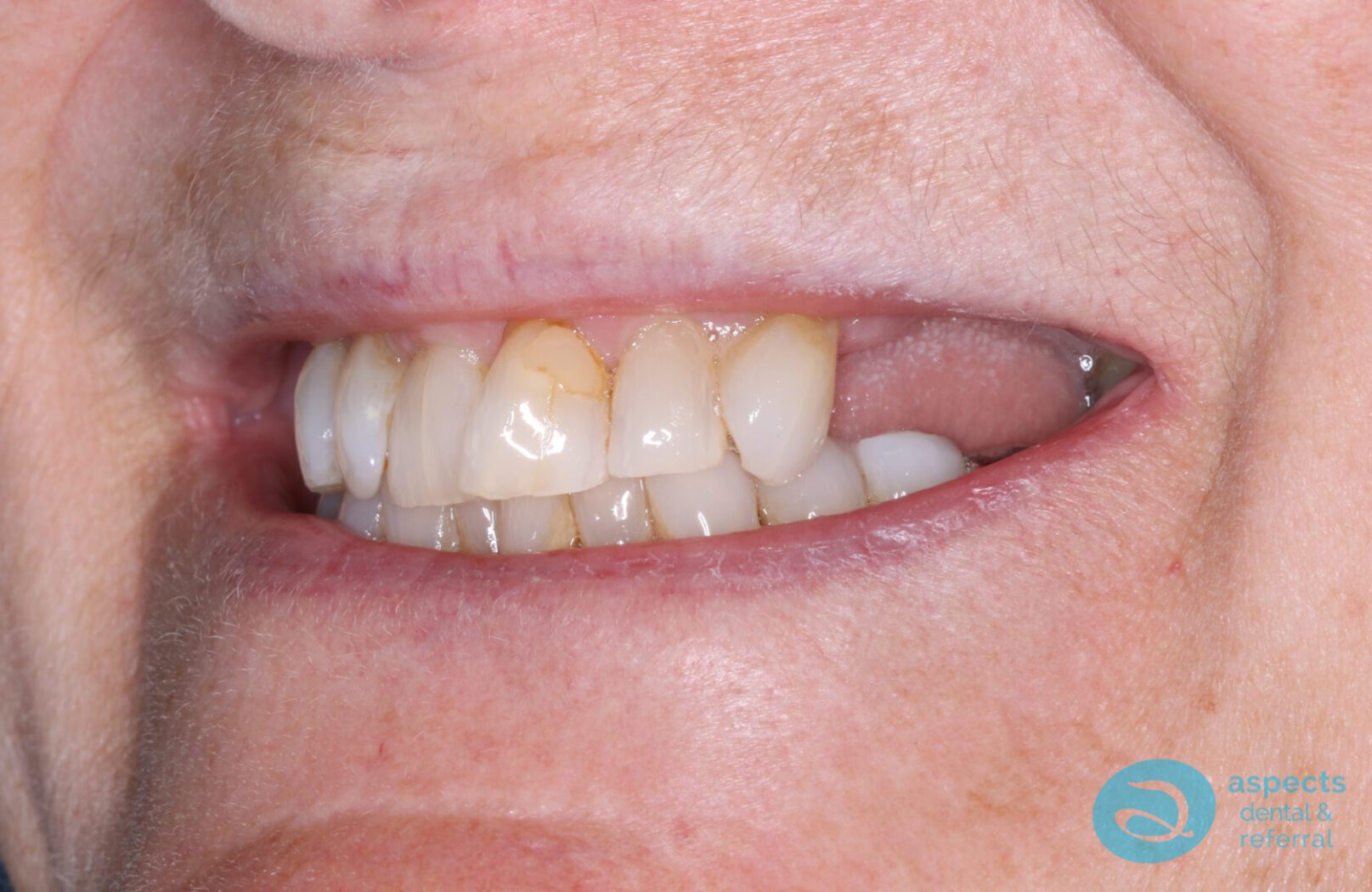 Before Dental Implants & Bridge Photo - Dental Implants Milton Keynes - Aspects Dental Case Study 26