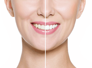 Teeth Whitening Bedfordshire - Boutique Teeth Whitening - Enlighten Teeth Whitening From Aspects Dental In Milton Keynes
