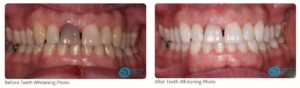 Milton Keynes Dentist Launches Boutique Teeth Whitening Special Offer - See Real Patient Smile Transformations