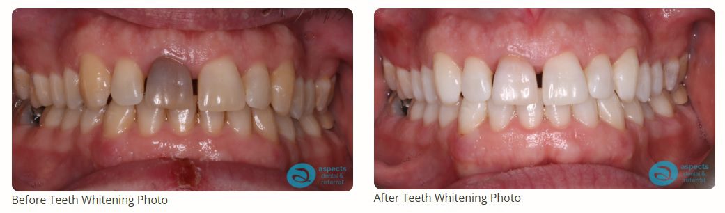 Milton Keynes Dentist Launches Boutique Teeth Whitening Special Offer - See Real Patient Smile Transformations Milton Keynes Dentist Launches Boutique Teeth Whitening Special Offer - See Real Patient Smile Transformations