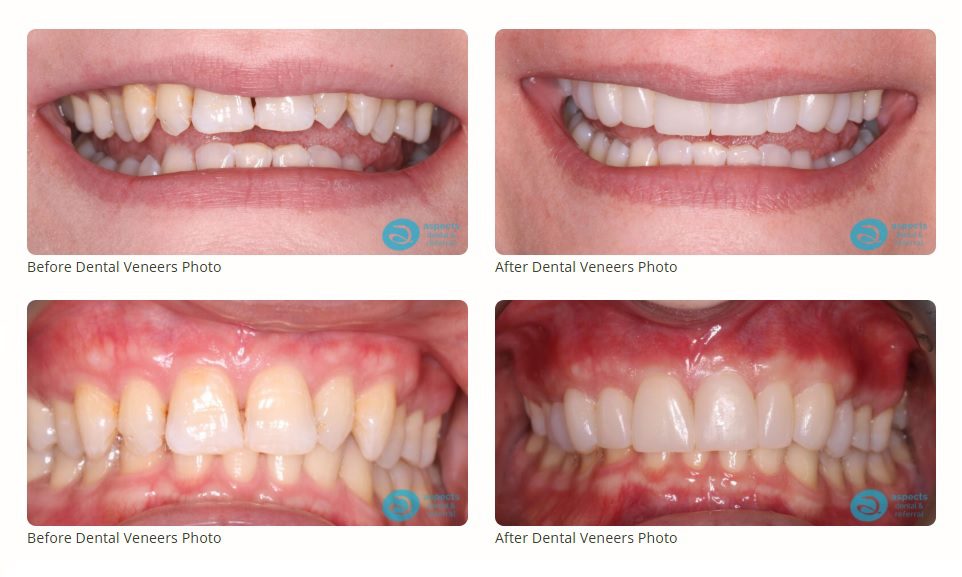 Milton Keynes Cosmetic Dentist Launches Composite Bonding Special Offer & Dental Veneers Special Offer - Before & After Photos