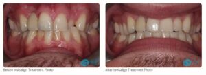 Milton Keynes Invisalign Dentist Launches New Invisalign Prices - See Our Invisalign Before & After Results