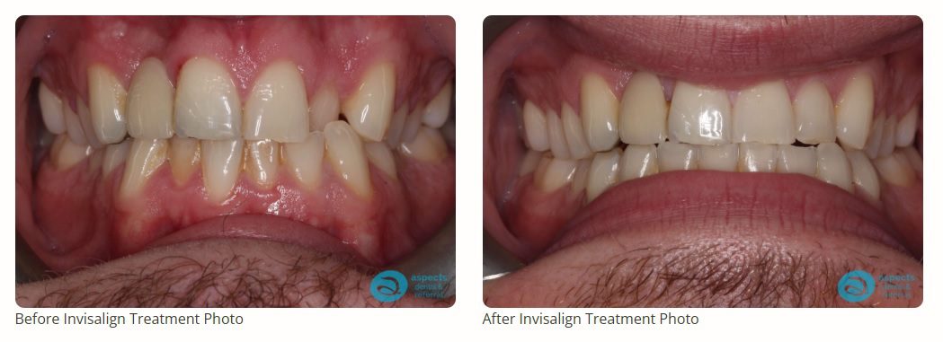 Milton Keynes Invisalign Dentist Launches New Invisalign Prices - See Our Invisalign Before & After Results