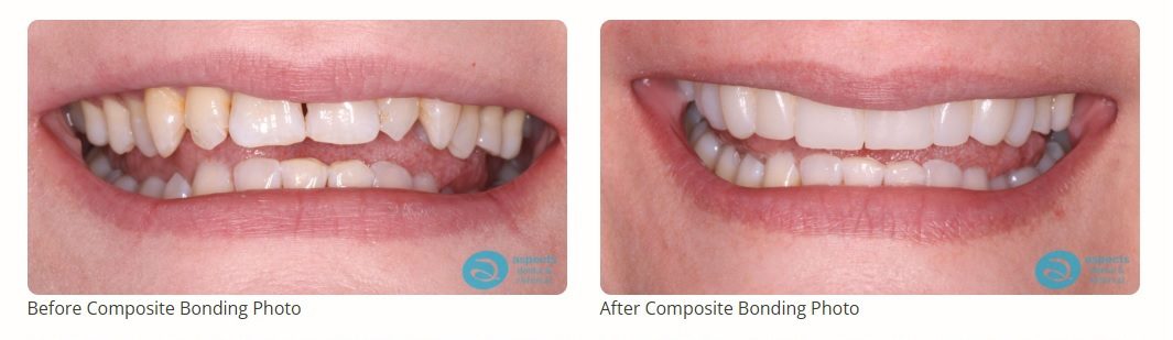 Milton Keynes Cosmetic Dentist Launches Autumn 2026 Special Offer - Composite Bonding Special Offer Milton Keynes - Before & After Photos